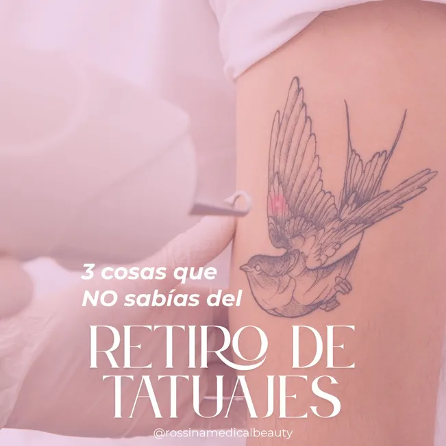 Retiro de tatuaje 1