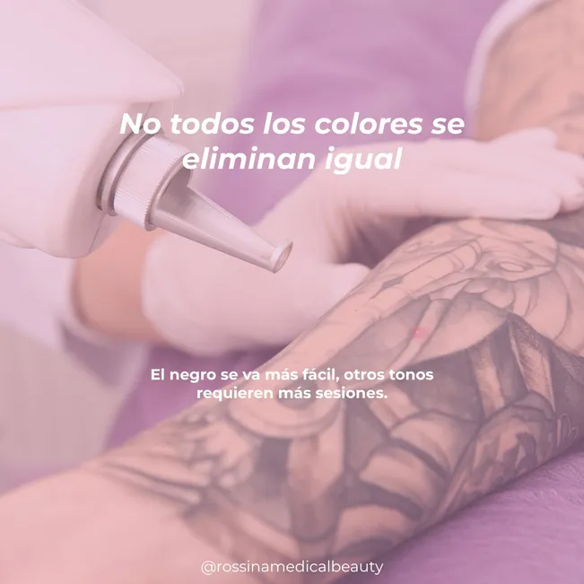 Retiro de tatuaje 3