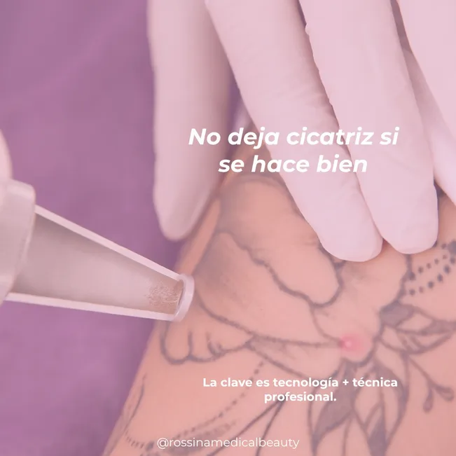Retiro de tatuaje 4